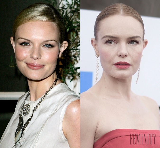 Ďalšia herečka Kate Bosworth sa na rozdiel od svojich kolegýň priznala k menším úpravám tváre